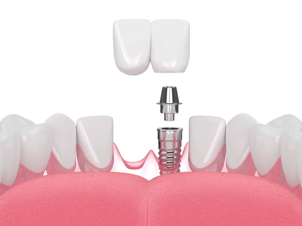 インプラントでサポートされている歯科用切開カンチレバーブリッジと顎の3Dレンダリング — ストック写真