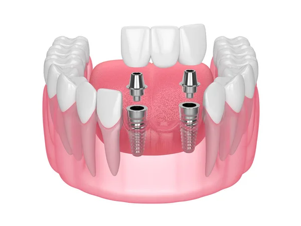 Beyaz Arkaplan Üzerinde Diş Köprüsü Destekleyen Implantlı Çene — Stok fotoğraf