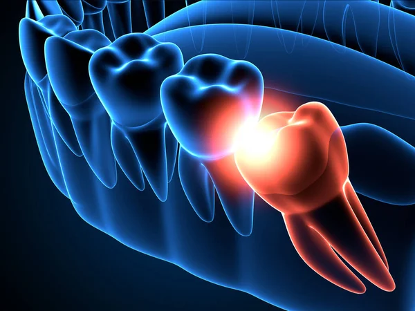 Renderização Raio Mandíbula Com Sabedoria Mesial Impacto Conceito Diferentes Tipos — Fotografia de Stock