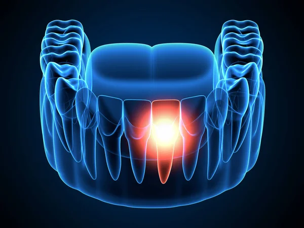 3d render of  jaw x-ray with aching molar tooth. Toothache concept.