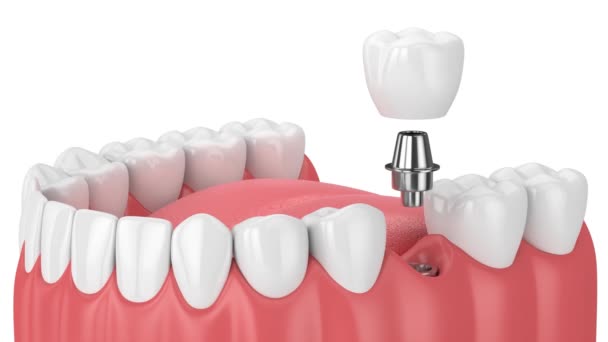 Mandíbula Com Colocação Implante Dentário Sobre Fundo Branco — Vídeo de Stock