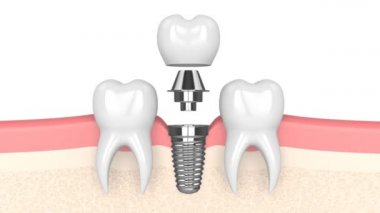 Beyaz arkaplan üzerine diş implantı yerleştirme