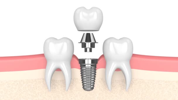 Colocação Implante Dentário Sobre Fundo Branco — Vídeo de Stock