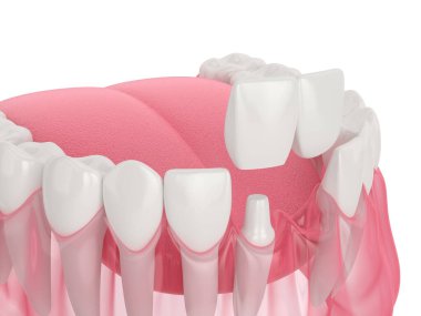 Beyaz arkaplan üzerinde diş cantilever köprüsü ile 3d çene oluşturma