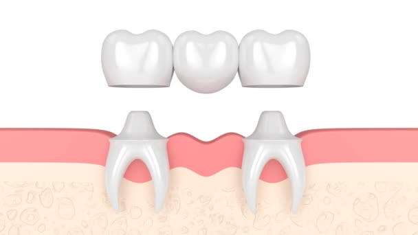 Gomas Com Ponte Molar Dental Sobre Branco — Vídeo de Stock