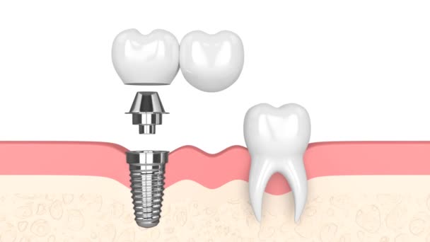 Dásně Implantátem Podporované Zubní Konzole Most Izolovaný Přes Bílé Pozadí — Stock video