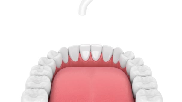牙龈与牙科聚合灯和轻固化镶嵌填充物 — 图库视频影像