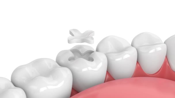 Diş Polimerizasyonu Lambasıyla Çene Hafif Iyileştirilmiş Dolgu Dolgusu — Stok video
