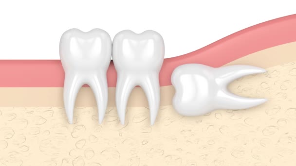 Dentes Gengivas Com Sabedoria Dente Impactação Horizontal — Vídeo de Stock