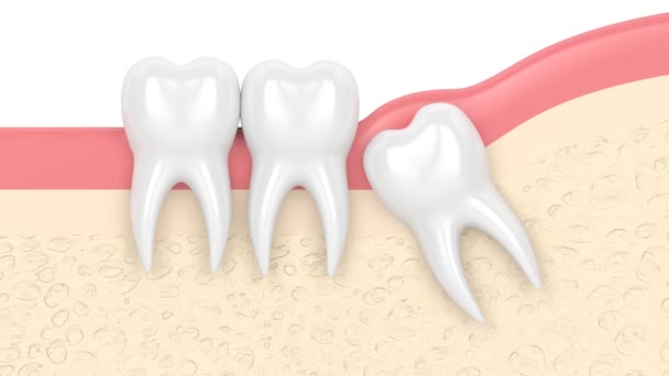 Wisdom Mesial Impaction Pericoronitis — Stock Video