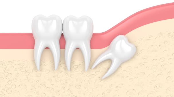 Impacto Distal Sabiduría Que Causa Dolor Daño Las Raíces — Vídeos de Stock