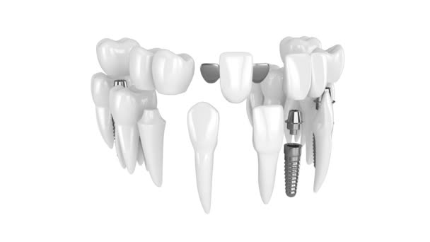 Ozubení Různými Typy Přestavby Zubů — Stock video