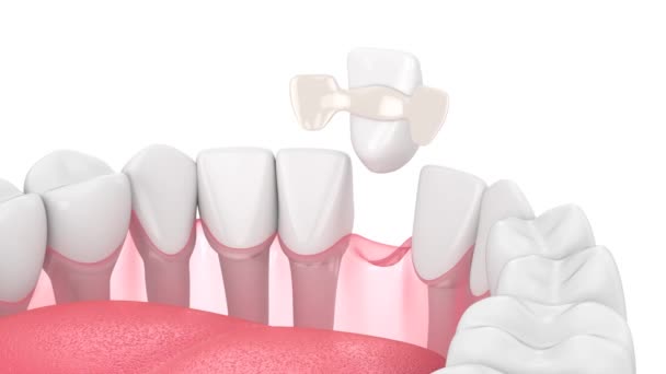 歯のメリーランド橋の配置と下顎 — ストック動画