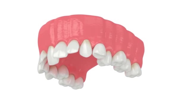 Maxilarului Superior Poziție Anormală Dinților Conceptul Tratamentului Ortodontic — Videoclip de stoc