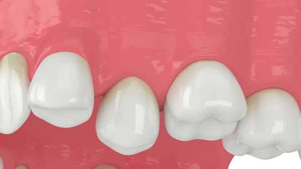 Primer Plano Mandíbula Superior Con Posición Anormal Los Dientes Concepto — Vídeos de Stock