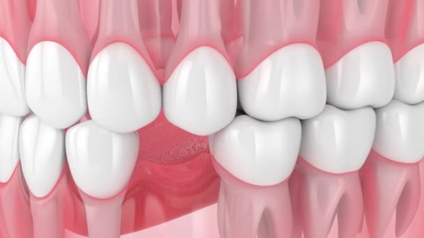 Dentes Deslizando Para Área Dente Perdido Consequências Perda Dentária — Vídeo de Stock