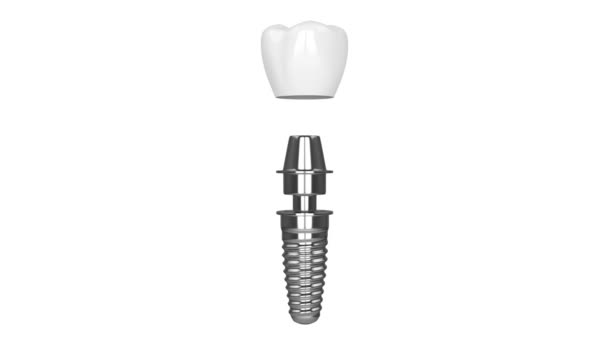 Instalación Implantes Dentales Sobre Fondo Blanco — Vídeo de stock