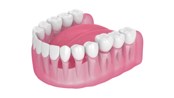 Jaw Dental Crown Embed Reshaped Tooth Transparent Background Animation Luma — Stock Video