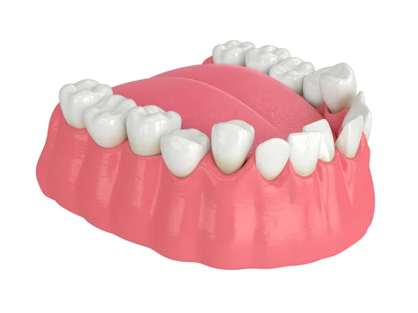 Renderizado Mandíbula Con Posición Anormal Los Dientes Concepto Tratamiento Ortodóncico —  Fotos de Stock