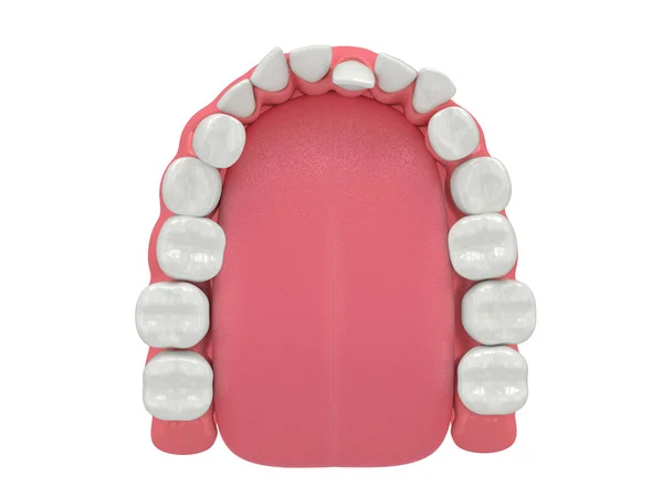 Återgivning Käken Med Onormalt Tandläge Ortodontisk Behandling — Stockfoto