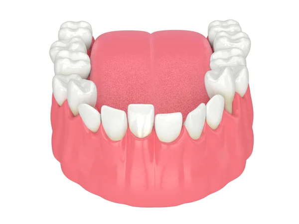 Weergave Van Kaak Met Abnormale Tanden Positie Orthodontisch Behandelingsconcept — Stockfoto