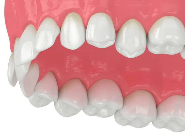 上颌骨的3D呈现 牙齿位置异常 牙齿矫正治疗的概念 — 图库照片