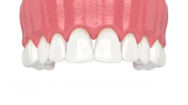 Açık gingival embrasure ile insan üst çene