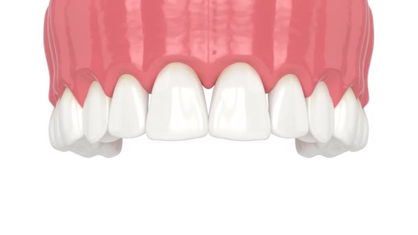 Верхняя Челюсть Человека Открытыми Десневыми Объятиями — стоковое видео