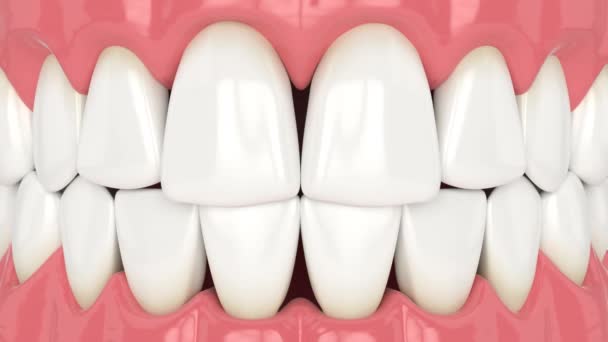 Ludzka Szczęka Czarnymi Trójkątami Między Zębami — Wideo stockowe