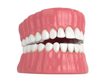 3d render of human jaw with black triangles between teeth isolated over white background clipart