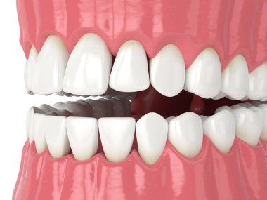 Beyaz arkaplan üzerinde izole edilmiş dişler arasında siyah üçgen ile insan çenesinin 3d yorumlayıcısı