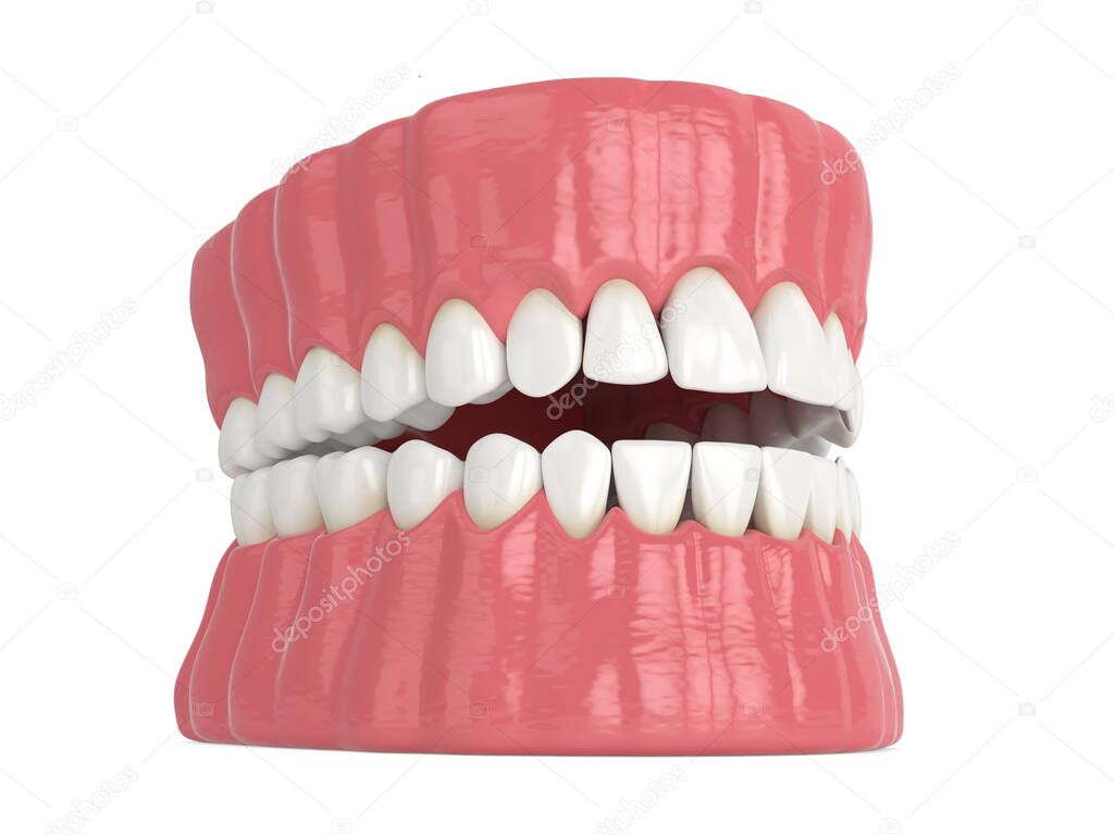 3d render of human jaw with black triangles between teeth isolated over white background