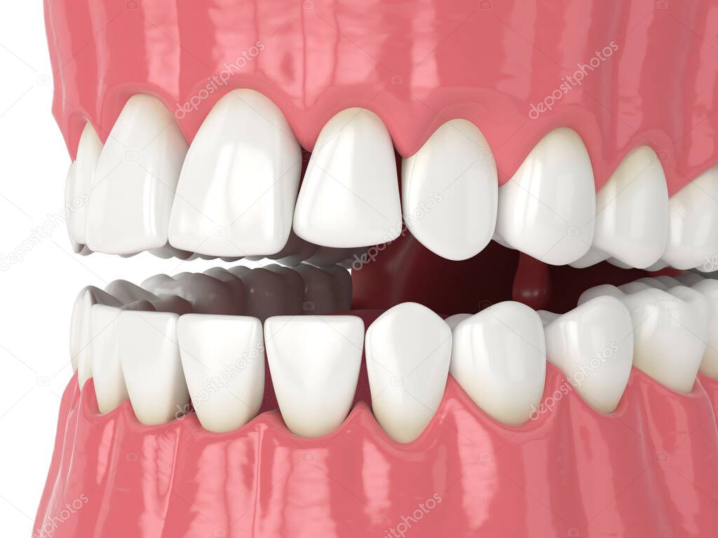 3d render of human jaw with black triangles between teeth isolated over white background