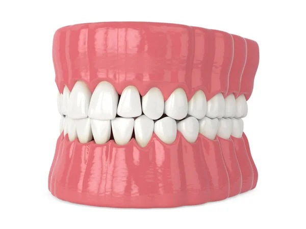 Renderowanie Szczęki Człowieka Czarnymi Trójkątami Między Zębami Izolowane Białym Tle — Zdjęcie stockowe