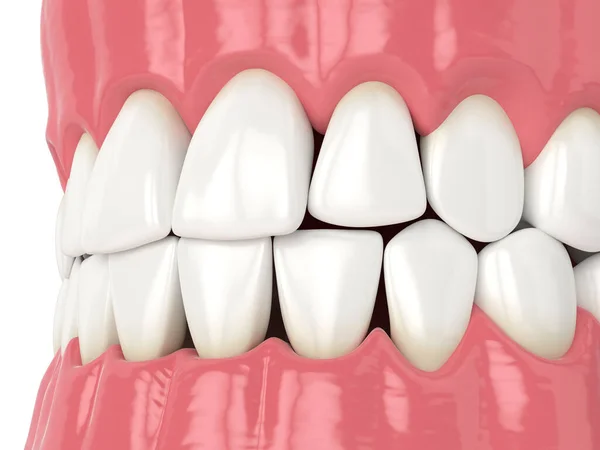 Renderização Mandíbula Humana Com Triângulos Pretos Entre Dentes — Fotografia de Stock