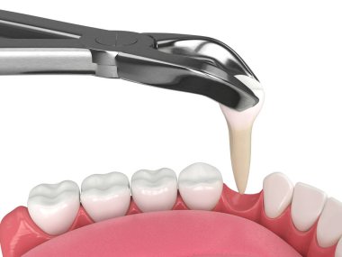 Diş kıskaçları tarafından çekilen alt çenenin 3d görüntüsü