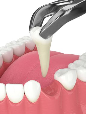 Diş kıskaçları tarafından çekilen alt çenenin 3d görüntüsü