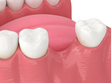 Beyaz üzerine diş kaybettikten sonra 3d çene kemik durgunluğu oluşturma