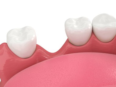 Beyaz üzerine diş kaybettikten sonra 3d çene kemik durgunluğu oluşturma