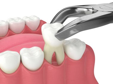Diş kıskaçları tarafından çekilen alt çenenin 3d görüntüsü