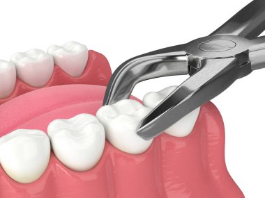 Diş kıskaçları tarafından çekilen alt çenenin 3d görüntüsü