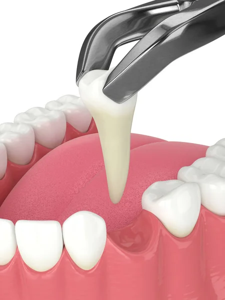 Rendering Della Mascella Inferiore Con Dente Estratto Pinze Dentali — Foto Stock