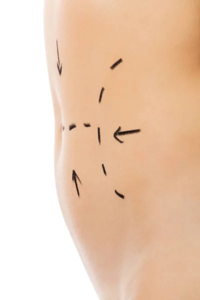 Woman body marked out for cosmetic surgery. — Stock Photo, Image