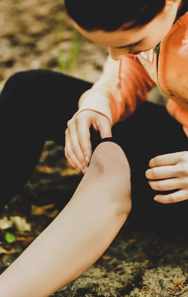 Bleeding scratched knee — Stock Photo, Image