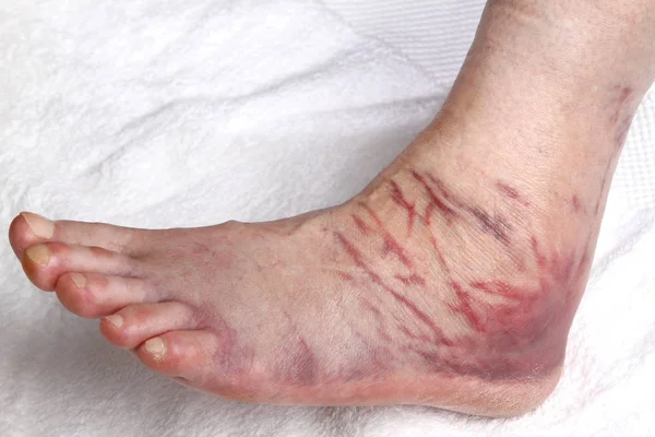 Geschwollener Fuß Nach Bänderriss — Stockfoto