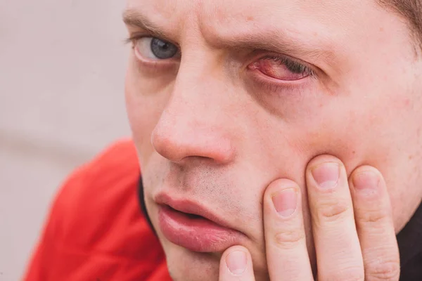 Broken blood vessel in man\'s eye. Man with the Subconjunctival hemorrhage.