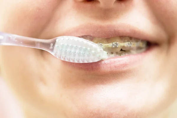 Mädchen mit Zahnspange beim Zähneputzen — Stockfoto