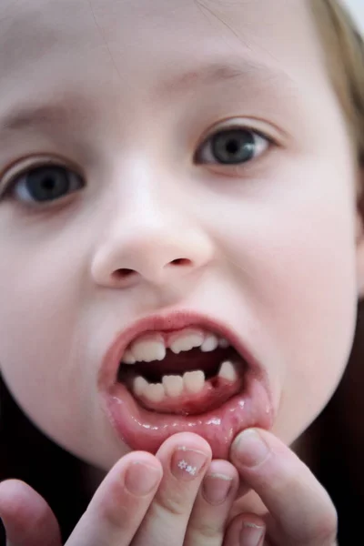 Engraçado Menina Sem Dentes Sorrisos Mostrando Lacuna Perto — Fotografia de Stock