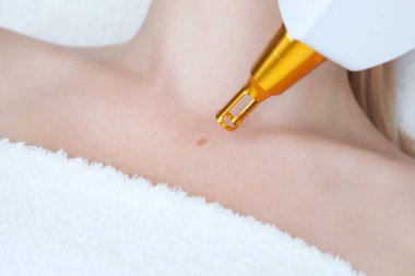 Güzellik Salonu bir kadının boynundaki lazer mol kaldırma