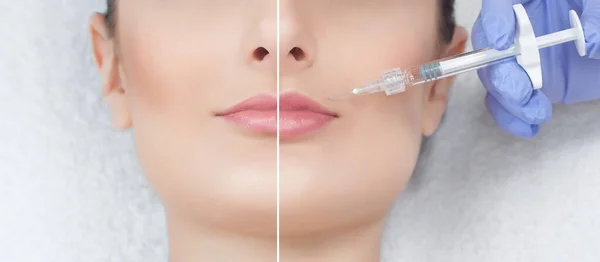 Cosmetologist Makes Injections Botulinum Toxin Lips Patient Close Photo Procedure — Stock Photo, Image